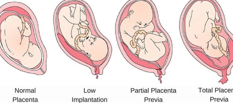 プラセンタ とはどういう意味 またどういうもの 英語で Placenta