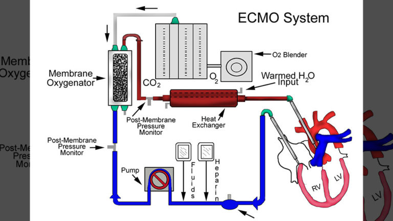 ECMO